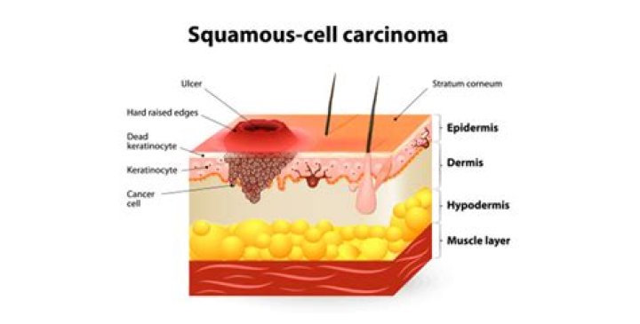 Where does squamous cell carcinoma spread?