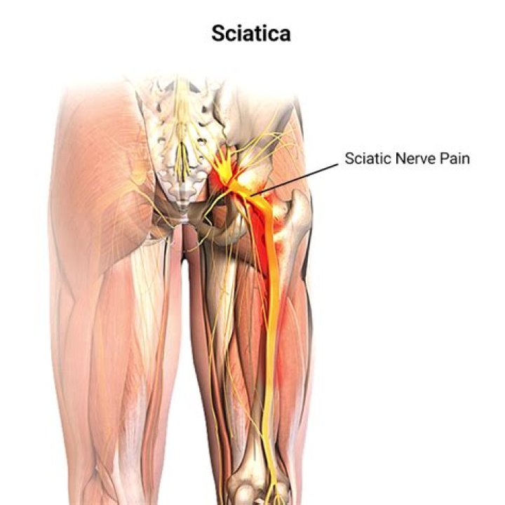 Where is sciatica pain felt?