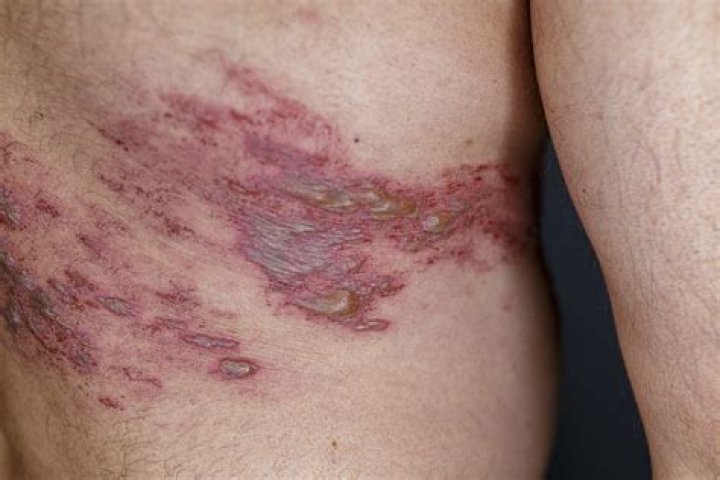 Who is more likely to get shingles?
