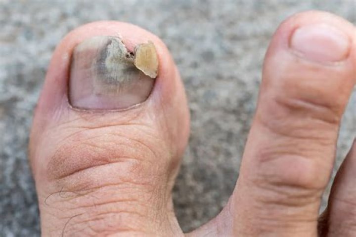 Why do elderly get thick toenails?