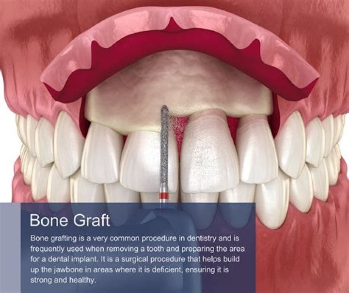Why do gum grafts fail?