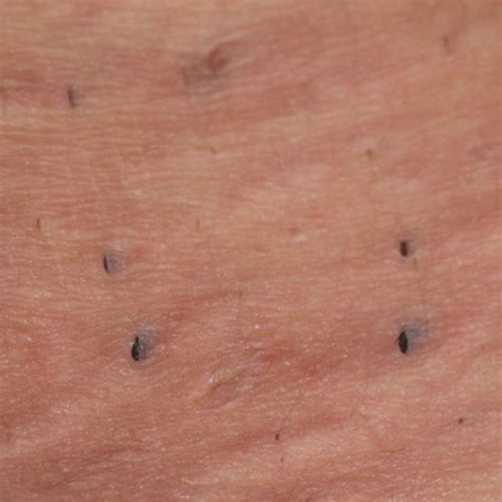 Why do I get blackheads in between my thighs?