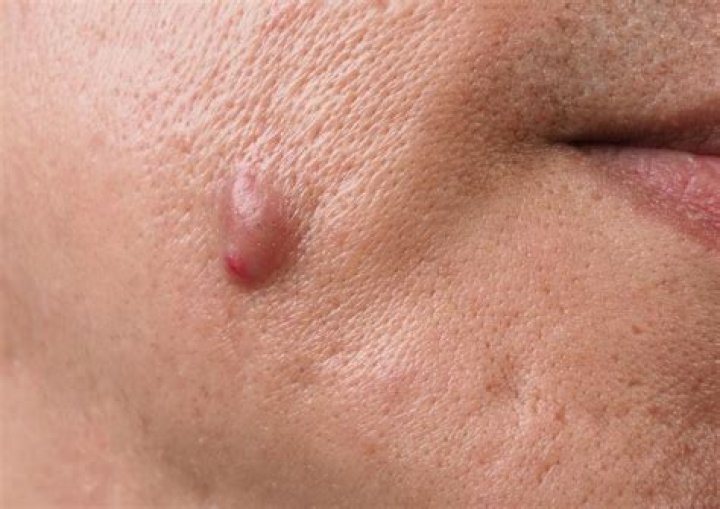 Why do I keep getting sebaceous cysts?