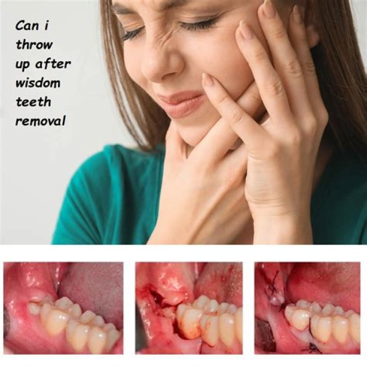 Why do you get stitches after wisdom teeth removal?