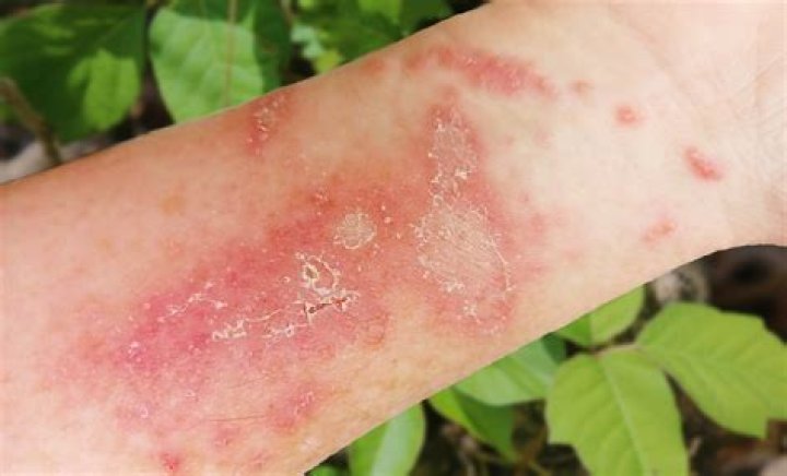 Why does hot water feel so good on poison ivy?