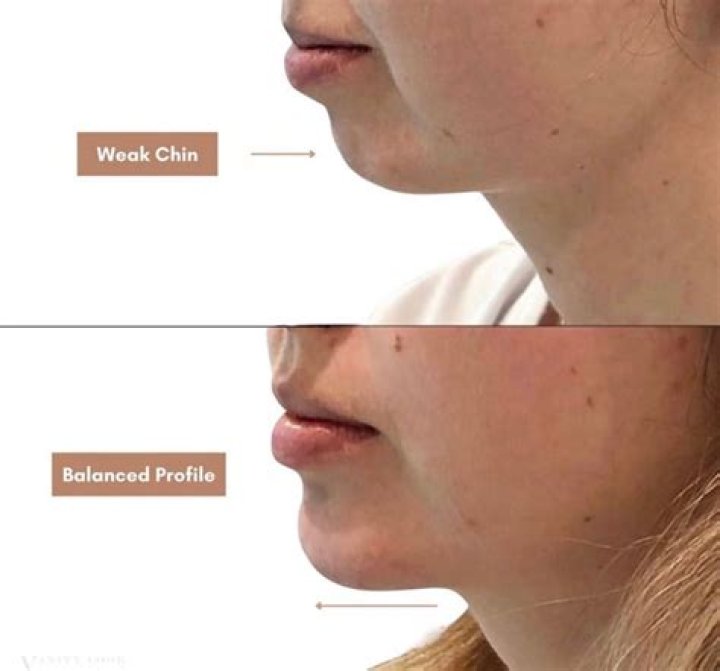 Why is my chin hair so thick?