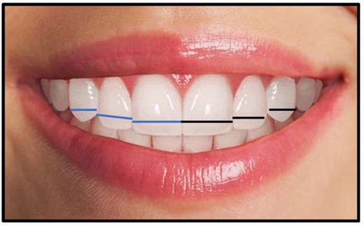 Why is my smile not straight?