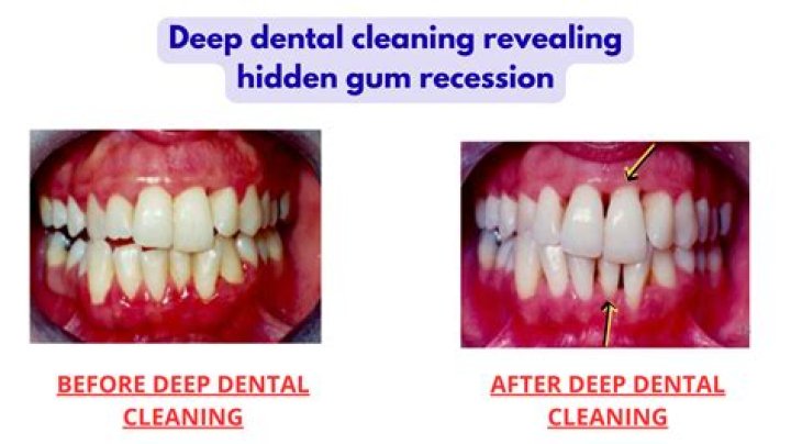 Will a deep cleaning help receding gums?